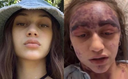 US Woman Fighting For Life After Vaccine Reaction At Hospital